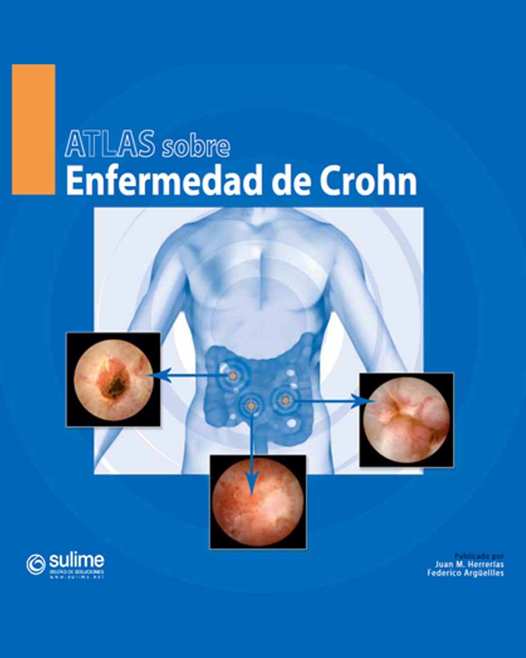 Atlas sobre Enfermedad de Crohn